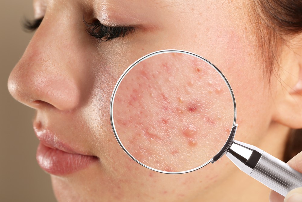 MỤN NỘI TIẾT KÉO DÀI: VÌ SAO ĐIỀU TRỊ BÊN NGOÀI KHÔNG HIỆU QUẢ?