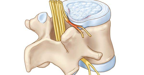 10 Bài Thuốc Tự Nhiên Tốt Nhất Cho Chứng Chèn Ép Dây Thần Kinh